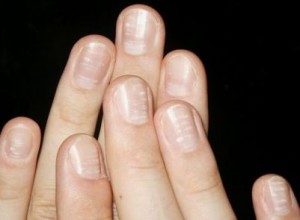 zinc deficiency nails
